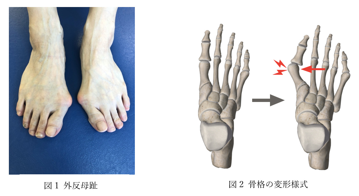 図1 外反母趾/図2 骨格の変形様式