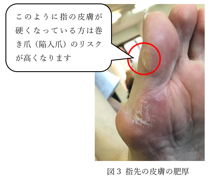図3 巻き爪のリスク