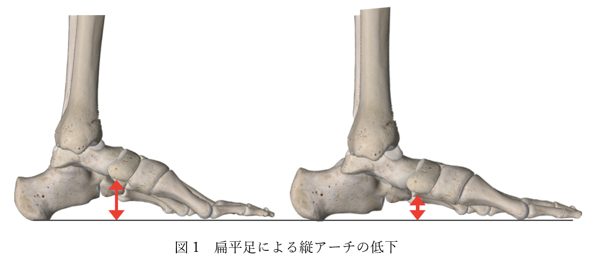 図1 扁平足による縦アーチの低下